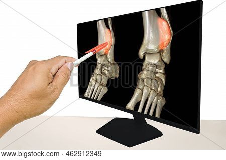 The Doctor Informed The Results Of X-ray Images Of The Ankle And Found Distal Tibia Bone Abnormaliti