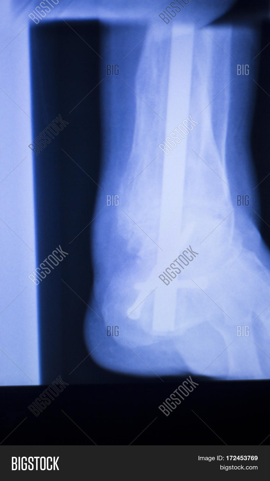 Xray Foot Heel Ankle Image & Photo (Free Trial) Bigstock