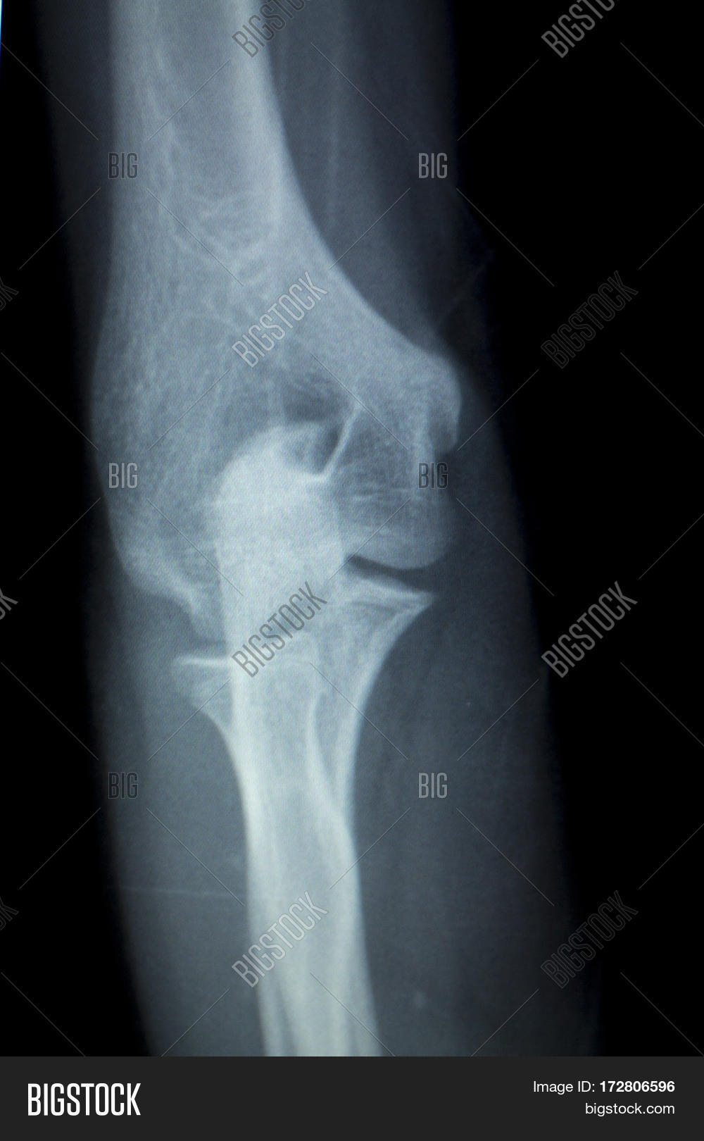 Elbow Joint Inury Xray Image & Photo (Free Trial) Bigstock