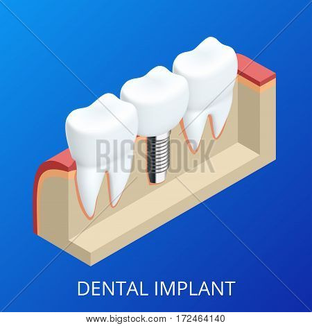 Isometric Tooth human implant. Dental concept. Human teeth or dentures. 3d illustration Isolated.