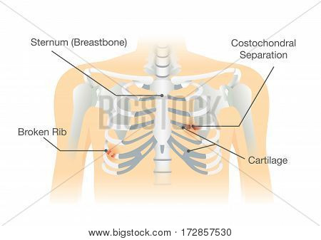 Human rib bone fractures fracture. Illustration is description of body injury.
