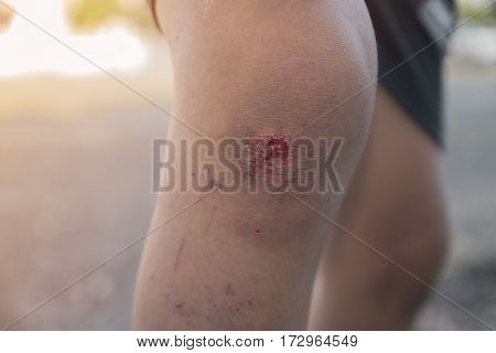 Infected wound on leg. Wounds caused by falling car