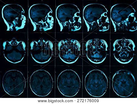 Magnetic Resonance Scan Of The Brain With Skull. Mri Head Scan On Dark Background Blue Color. X-ray 
