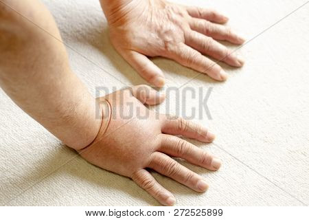 Looking Down On A Pair Of Hands, One Of Which Is Swollen Due To A Hornet Sting.close Up.