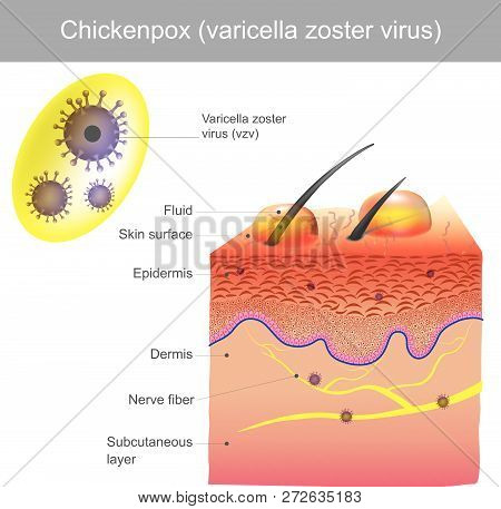 Transmitted By Inhalation Of Varicella Virus In Aerosol. The Skin Infections And Have A Fever. A Pai