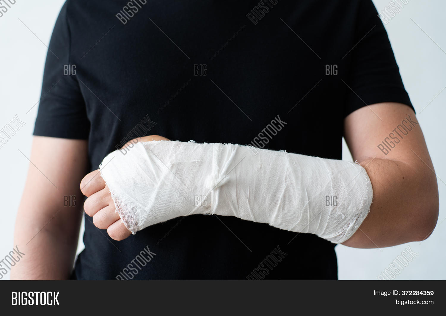 Broken Hand Gypsum Image & Photo (Free Trial) Bigstock