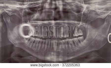 Orthopantomogram. Panoramic Dental X-ray Of An Adult Person. Bad Teeth Fell Out. Snapshot Of The Sen