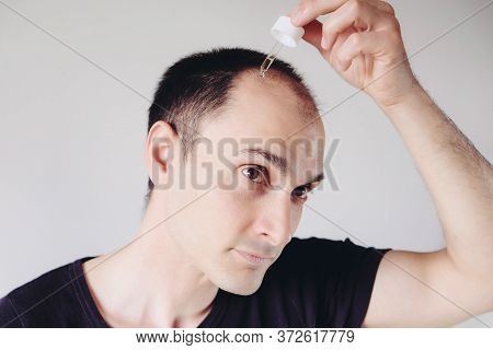 Young Caucasian Man Looking At Mirror And Applying Anti-hair Loss Concentrate Serum.