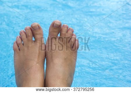Top View Of Female Legs With Fused Middle Toes On Blue Pool Background. Webbed Toes Genetic Disorder