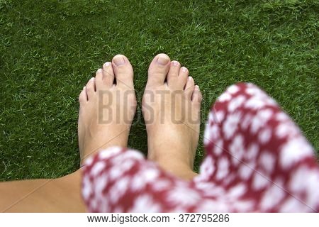 Top View Of Female Legs With Fused Middle Toes On Green Grass Background. Webbed Toes Genetic Disord