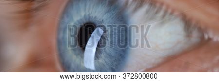 Male Eye Blu Color Super Macro Closeup Shot. Laser Vision Correction And Cataract Treatment Concept
