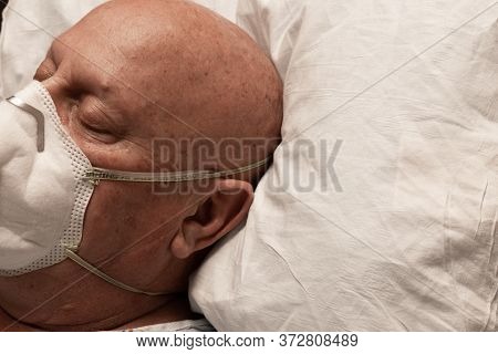 Head Of A Man With Oxygen Lines And Respirator Asleep On A Pillow, Bald Cancer Chemotherapy With Cor