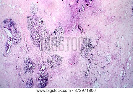 Breast Fibroadenosis, Light Micrograph, Photo Under Microscope. Common Benign Hyperplastic Process I