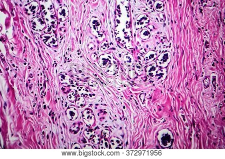 Breast Ductal Carcinoma, Light Micrograph, Photo Under Microscope