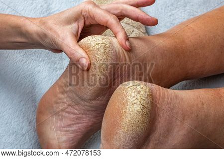 Cracks On The Heels Of A Persons Foot, Foot Health Problems, Neglected Heel Of A Person. A Doctor Ex