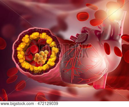 Medical Background, Cholesterol Plaque In The Artery, Increased Level, 3d Rendering