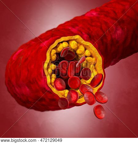 Medical Background, Cholesterol Plaque In The Artery, Increased Level, 3d Illustration