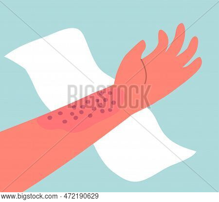 Dermatitis On The Skin Of A Human Hand. Dermatological Disease. The Symptom Is Itching, Pain, Rednes