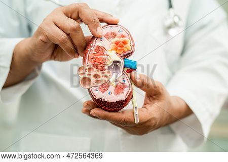 Kidney Disease, Chronic Kidney Disease Ckd, Doctor Hold Model To Study And Treat In Hospital.