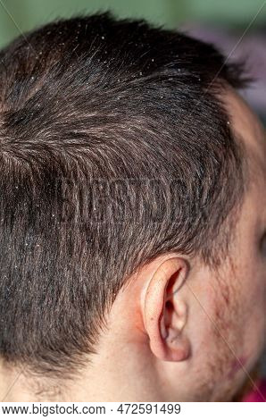 The Back Of A Mans Head With Dandruff In His Hair, Seborrhea Skin Disease
