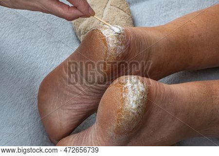 Heel With Dry Skin And Cracks. Medical Pedicure. An Orthopedic Doctor Applies A Healing Cream To The