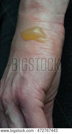 Close-up Of A Woman's Hand With A Blister From A Boiled Water Burn, Damaged Skin, 1st Or Second Degr