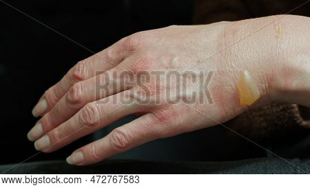 Close-up Of A Woman's Hand With A Blister From A Boiled Water Burn, Damaged Skin, 1st Or Second Degr