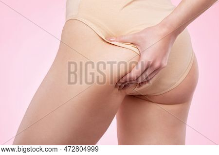 The Girl Stretches The Skin On Her Leg, Showing Fat Deposits And Cellulite. The Concept Of Weight Lo