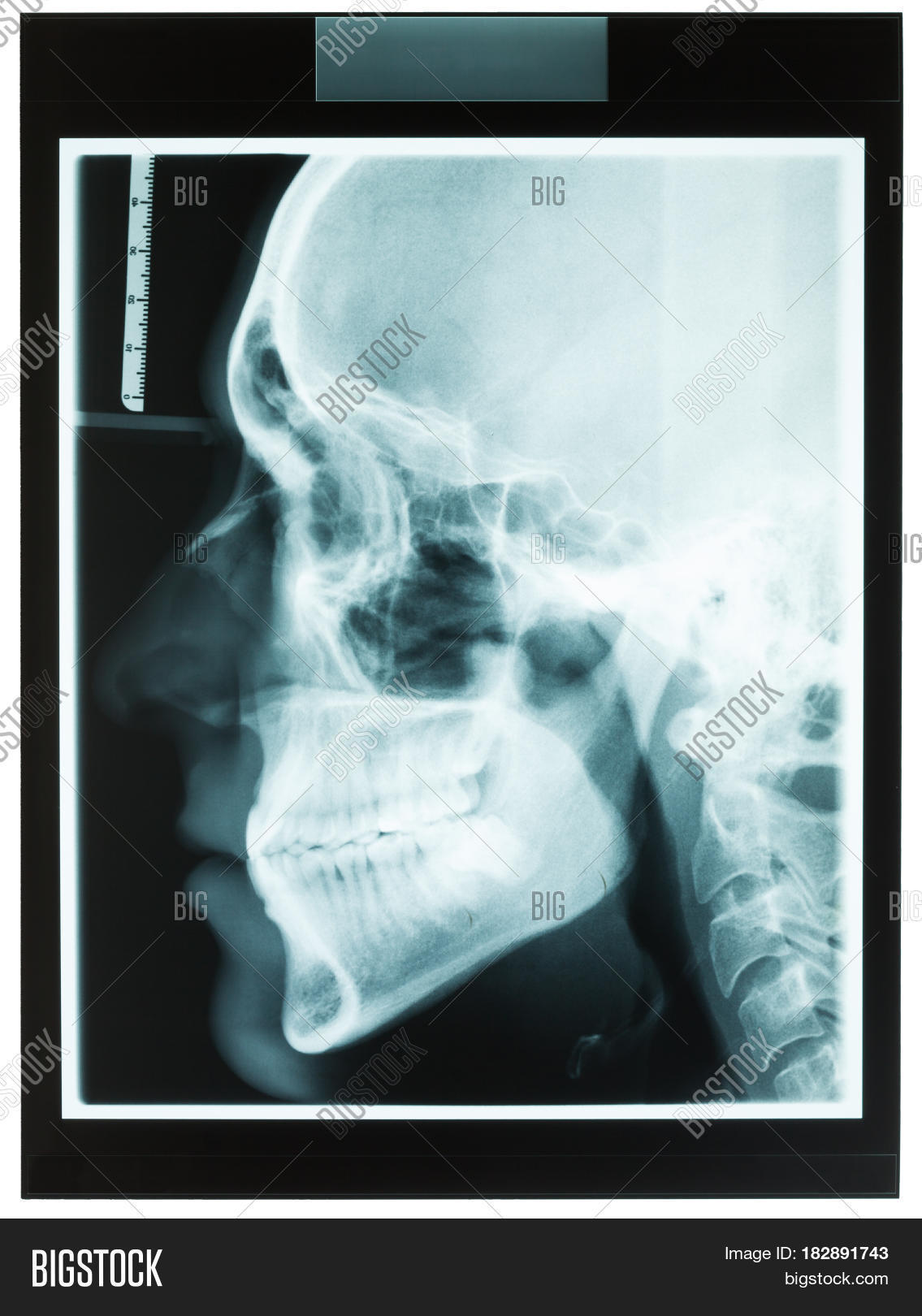 Profile Xray Man's Jaw Image & Photo (Free Trial) Bigstock