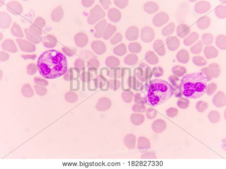Abnormal Neutrophil In Blood Smear.