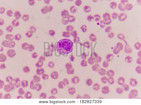 Abnormal Neutrophil In Blood Smear.