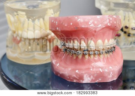 Human jaw or teeth orthodontic dental model with implants dental braces