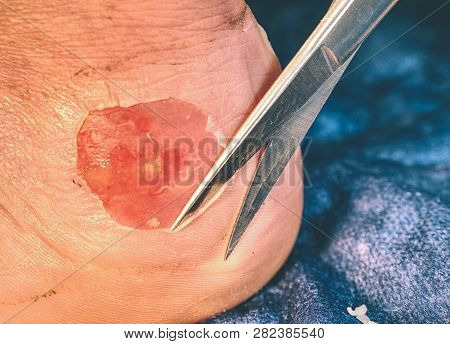 Nurse Cleaning Dead Skin On Patient Leg With Spike Scissors, Blue Sterile Background.  Deep Scratche