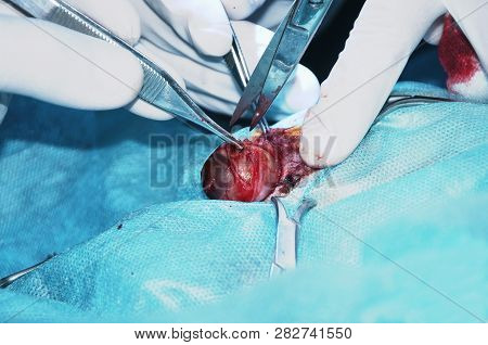 Surgery Resection Of The Eye. Close Up.