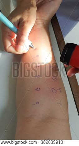 Arm Examine With Allergy Skin Prick Test Rash Reaction Aero Dust Mite Sensitive