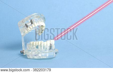Dental Jaw Model On Blue Background With Laser. The Concept Of Treatment Of Caries And Pulpitis With