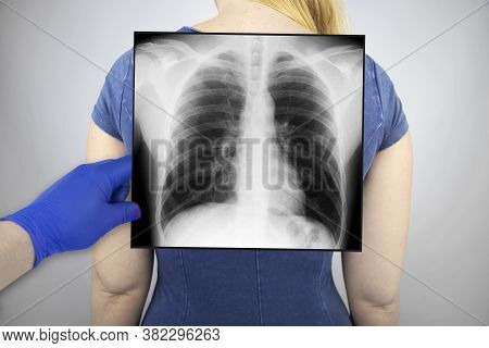 X-ray Of The Chest Of A Woman. A Doctor Radiologist Is Studying An X-ray Examination. A Picture Of T