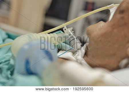 Patient Do Tracheostomy And Ventilator In Hospital