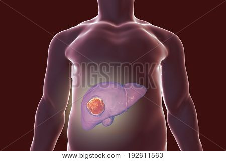 Liver cancer. 3D illustration showing presence of tumor inside liver