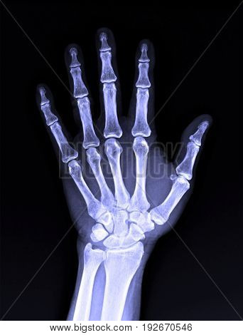 X-ray Image Of Male Human Hand