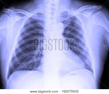 X-ray Image Of Male Human Chest
