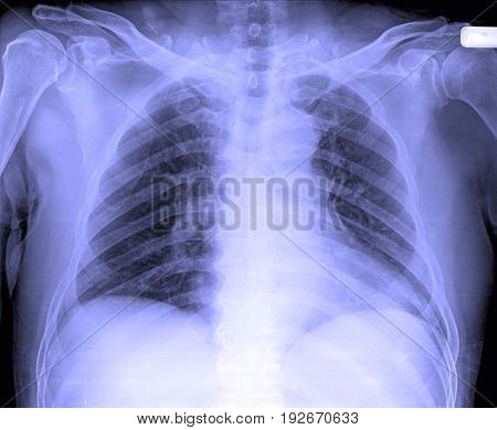X-ray Image Of Male Human Chest