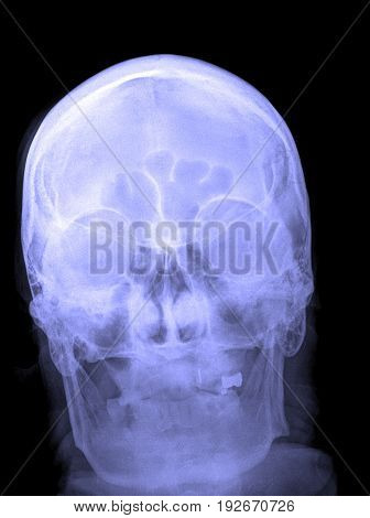 X-ray Picture Of The Skull