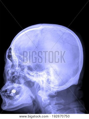 Film X-ray Skull And Cervical Spine Lateral View