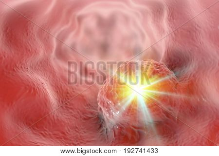 Treatment of esophageal cancer concept, 3D illustration