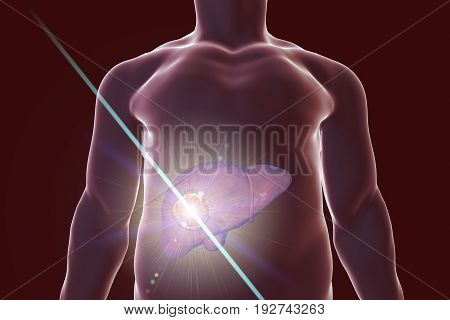 Liver cancer treatment with laser. Conceptual image. 3D illustration