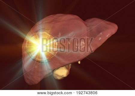 Liver cancer treatment. Conceptual image. 3D illustration