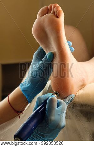 Podiatrist Using Grinding Equipment And Making Procedure Polish For Feet Hardware Pedicure. Callus P