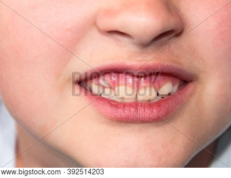 Children's Teeth. The Molar Grows In The Second Row. Anomalies Of Tooth Growth.