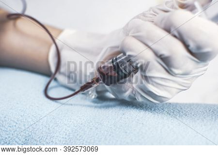 Venipuncture With A Medical Syringe (sucked Blood From Patient With Medical Syringe)
